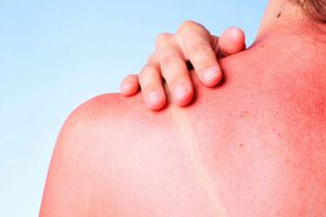 Алергія на сонце — фотодерматоз. Чим її лікувати? фото